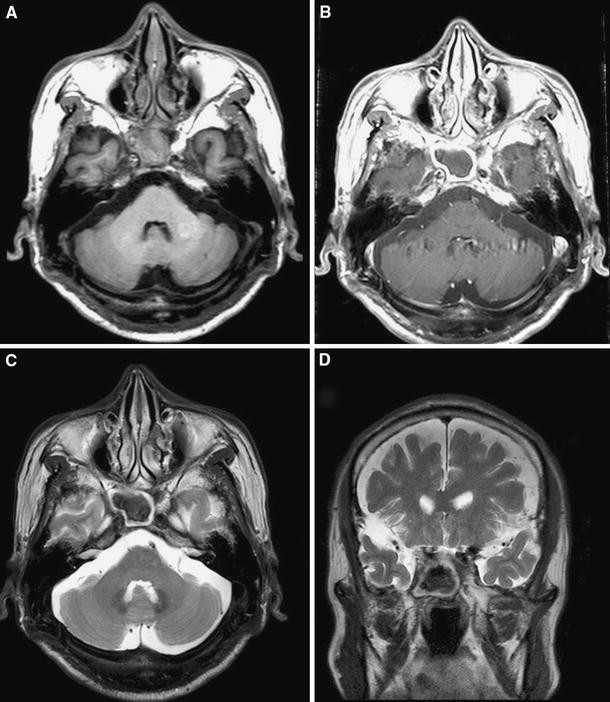 Headache Induced By Isolated Sphenoid Fungal Sinusitis Sinus Headache The Journal Of Headache And Pain Full Text Headache Induced By Isolated Sphenoid Fungal Sinusitis Sinus Headache The Journal Of Headache And Pain Full Text