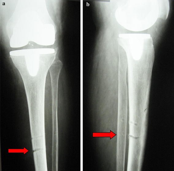 medial tibial stress fracture