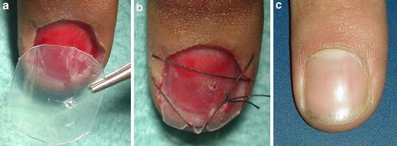 Surgical treatment of acute fingernail injuries | Journal of Orthopaedics  and Traumatology | Full Text
