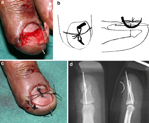 Surgical treatment of acute fingernail injuries | Journal of Orthopaedics  and Traumatology | Full Text