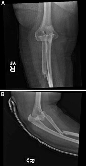 Divergent Elbow Dislocation With Radial Shaft Fracture Distal Ulnar Deformation And Distal Radioulnar Joint Instability An Unclassifiable Monteggia Variant Springerlink