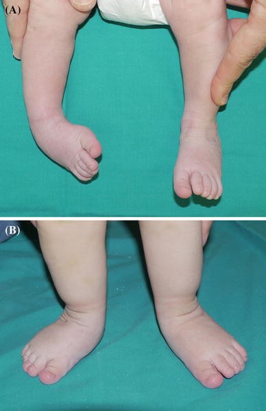 Congenital Idiopathic Talipes Equinovarus Before And After Walking Age Observations And Strategy Of Treatment From A Series Of Cases Journal Of Orthopaedics And Traumatology Full Text Congenital Idiopathic Talipes Equinovarus Before And After Walking Age Observations And Strategy Of Treatment From A Series Of Cases Journal Of Orthopaedics And Traumatology Full Text