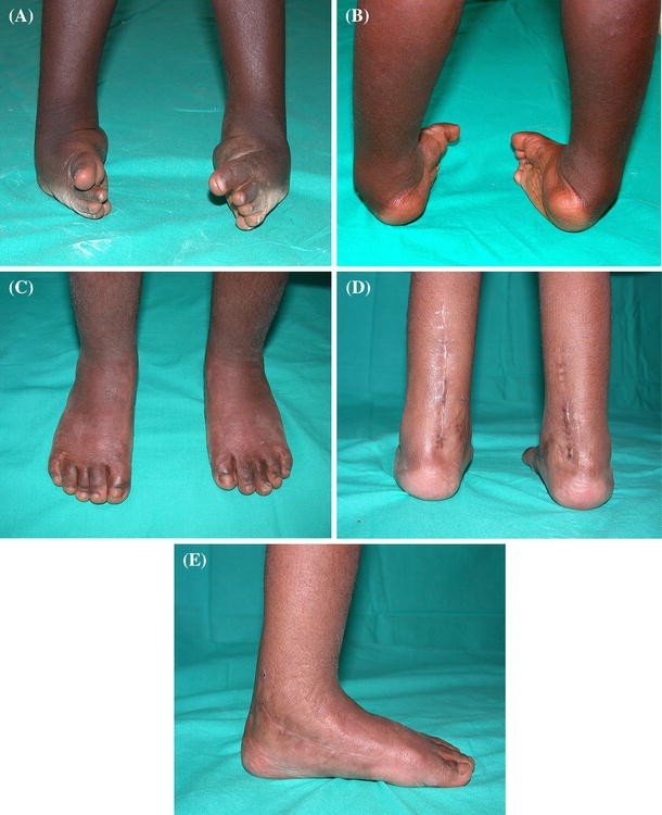Congenital Idiopathic Talipes Equinovarus Before And After Walking Age Observations And Strategy Of Treatment From A Series Of Cases Journal Of Orthopaedics And Traumatology Full Text