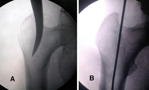 Retrograde entry portal for femoral interlocking nailing in femoral  nonunion after plate failure: a prospective comparative study with  antergrade portal | Journal of Orthopaedics and Traumatology | Full Text