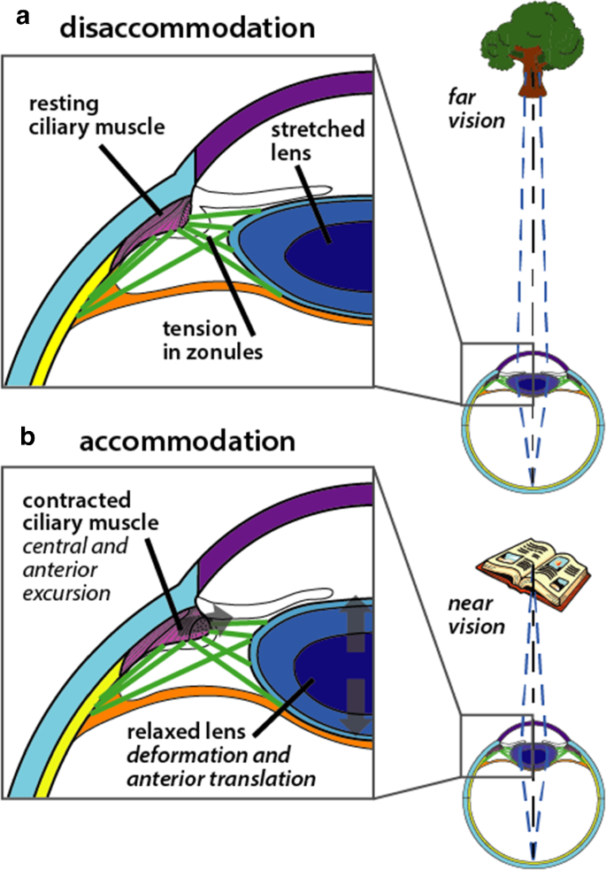 The action of ciliary muscle contraction on accommodation of the lens  explored with a 3D model | SpringerLink