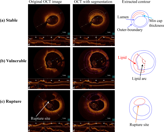 Morphological and biomechanical classifications of coronary plaque ...