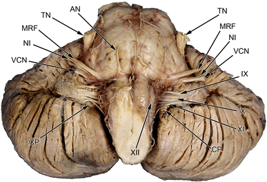 Mandibular nerve - Gross Anatomy 