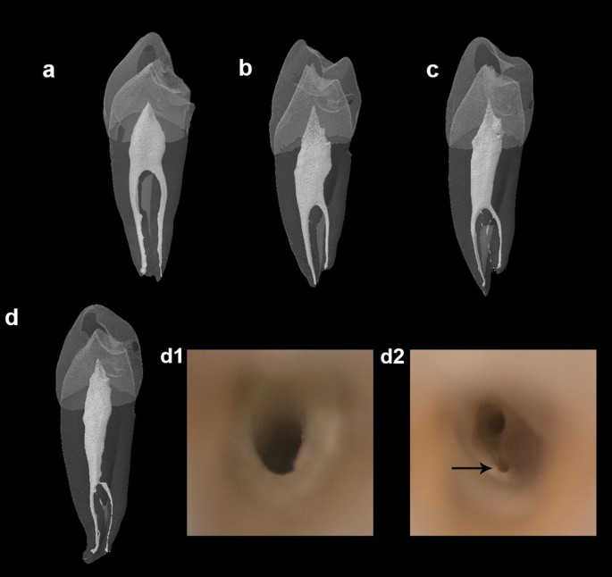 mandibular first molar canals