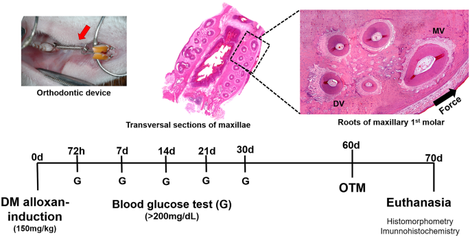 Pulpal outcomes in orthodontic tooth movement in diabetes mellitus |  SpringerLink