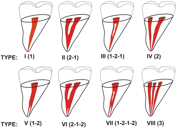 maxillary first premolar canals