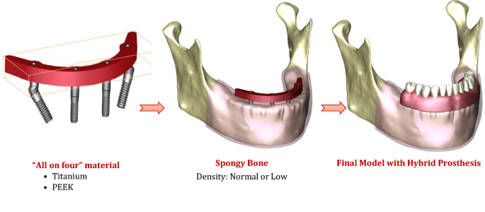 Evaluation of stress and strain on mandible caused using “All-on 