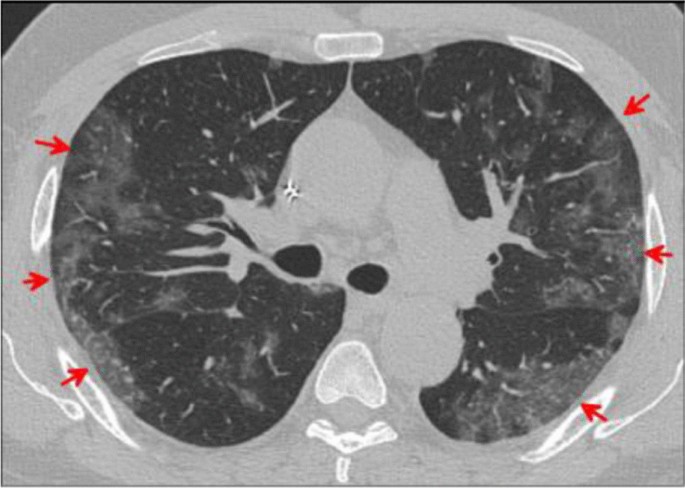 Clinical Application Of Chest Computed Tomography Ct In Detection And Characterization Of Coronavirus Covid 19 Pneumonia In Adults Springerlink