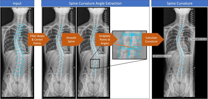 كيف يساعد الذكاء الاصطناعي في تشخيص اعوجاج العمود الفقري؟