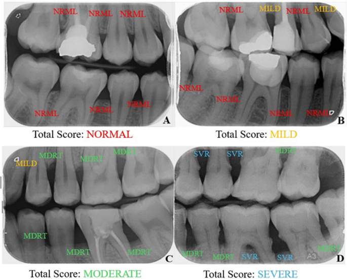 Deep Convolutional Neural Network for Automated Staging of Periodontal ...