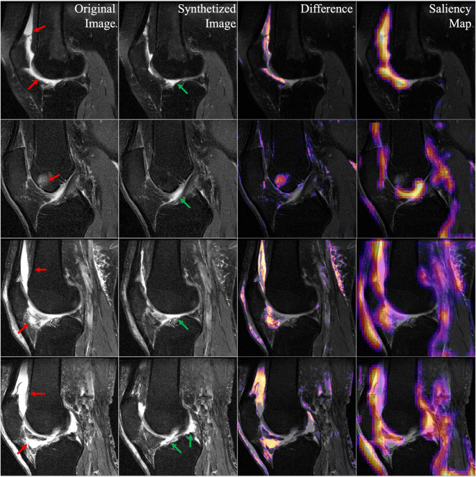 Localizing Knee Pain via Explainable Bayesian Generative Models and ...