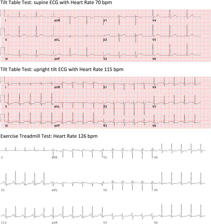 Tilt table test: Procedure, results, and more