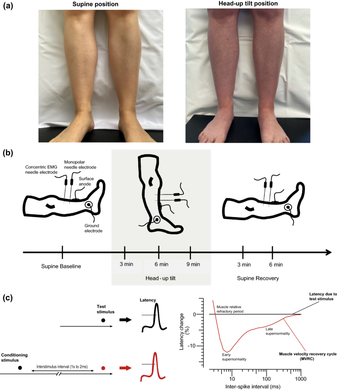 Leg pain in neuropathic postural tachycardia syndrome is associated with  altered muscle membrane properties | SpringerLink