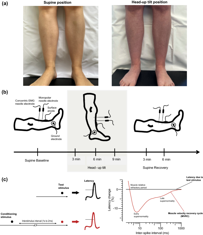 muscle weakness in legs