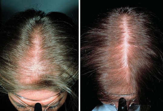 Therapie der androgenetischen Alopezie der Frau mit Minoxidil-Lösung |  SpringerLink