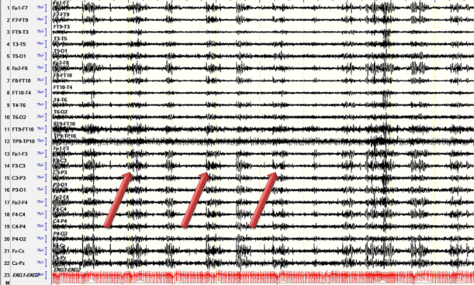 Nicht-epileptische motorische Phänomene im Schlaf | SpringerLink