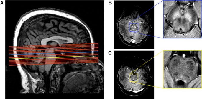 Reproducibility Of Locus Coeruleus And Substantia Nigra Imaging With Neuromelanin Sensitive Mri Springerlink