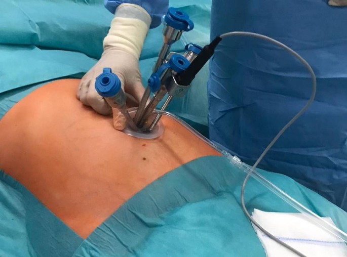 Robotic multiport versus robotic single-site cholecystectomy: a  retrospective single-centre experience of 142 cases | SpringerLink