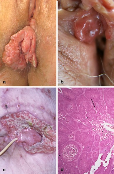 Unguent condilom vulva