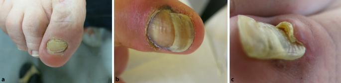 Retronychia—an uncommon cause of chronic proximal nail fold inflammation | SpringerLink Retronychia—an uncommon cause of chronic proximal nail fold inflammation | SpringerLink