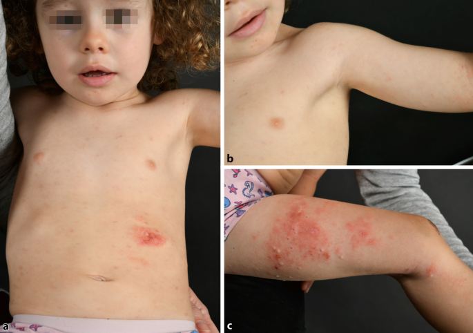 Hypopyon Sign As An Unusual Complication Of Varicella Infection In A Girl With Atopic Dermatitis Springerlink Hypopyon Sign As An Unusual Complication Of Varicella Infection In A Girl With Atopic Dermatitis Springerlink