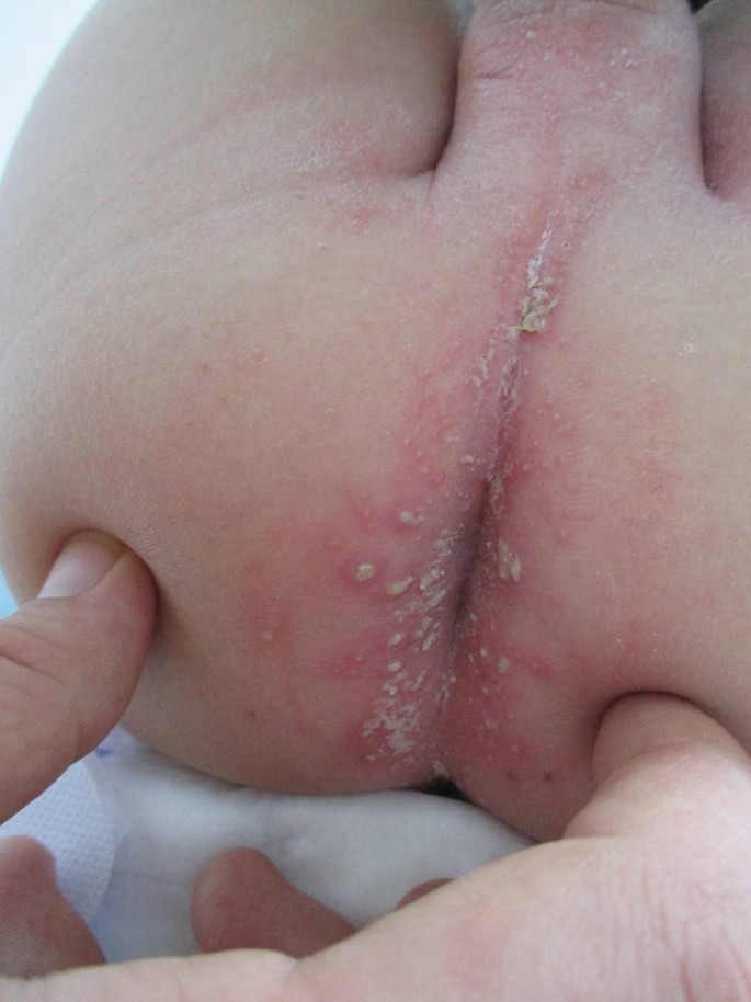 Cureus, Atypical Presentation of Scarlet Fever