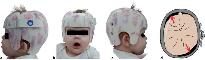 Diagnostic and treatment possibilities in the management of positional  plagiocephaly | Wiener Medizinische Wochenschrift
