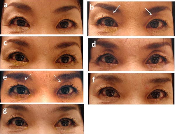 Recovery from deepening of the upper eyelid sulcus after switching from bimatoprost to latanoprost | SpringerLink Recovery from deepening of the upper eyelid sulcus after switching from bimatoprost to latanoprost | SpringerLink