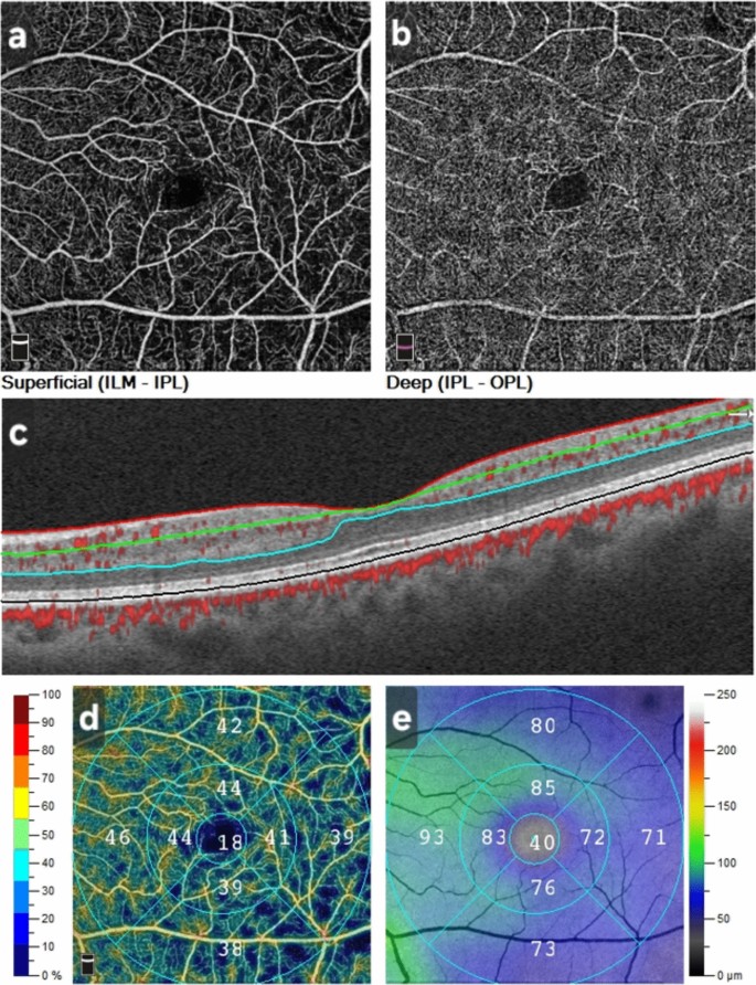 Assessment of retinal, choroidal and peripapillary microvascular ...