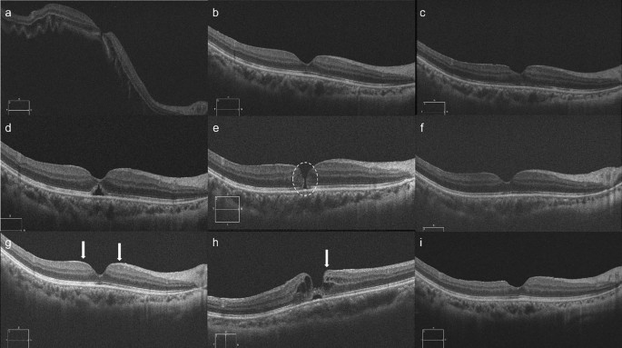 Macular hole following vitrectomy for rhegmatogenous retinal detachment ...