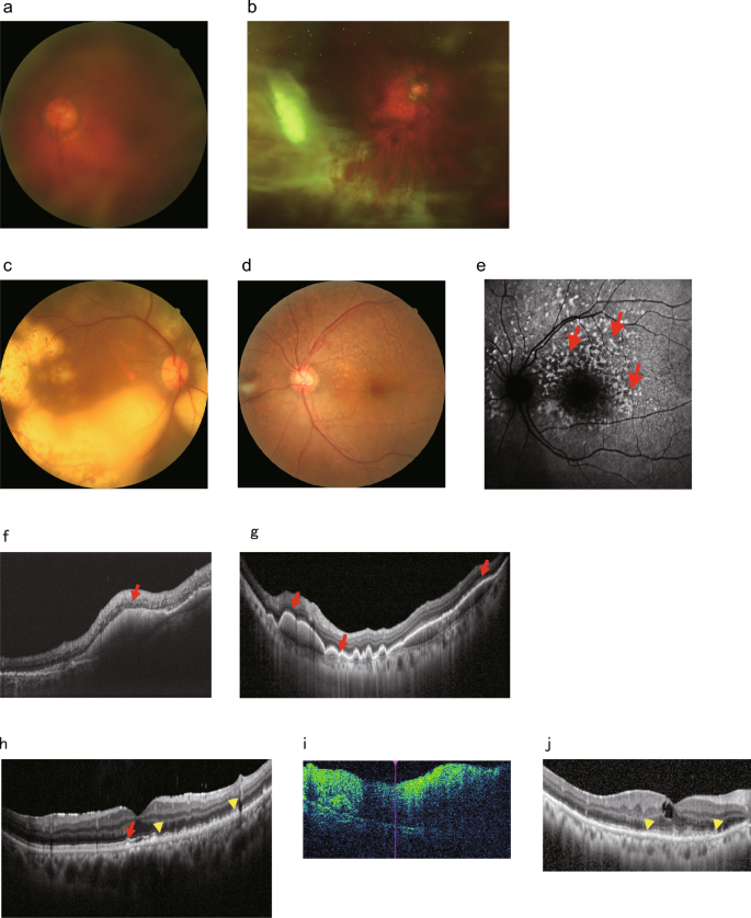 Recent advances in the diagnosis and treatment of refractory ocular ...