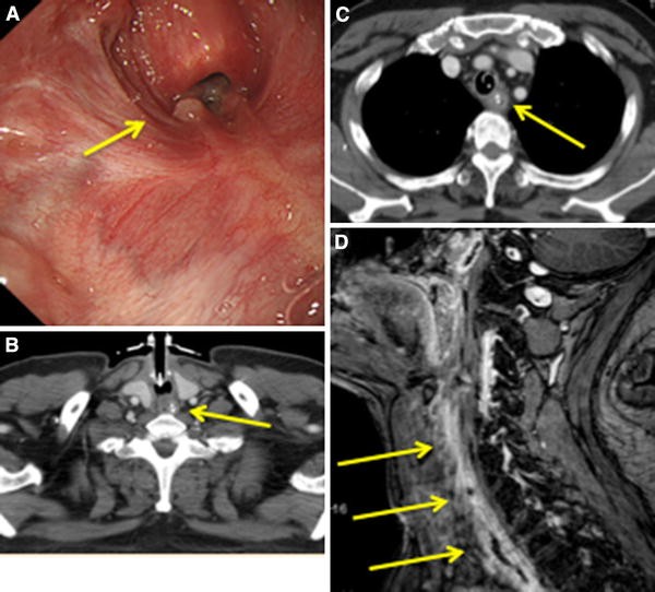 Pharyngo-laryngo-esophagectomy and reconstruction with a gastric tube for  corrosive pharyngoesophagitis | SpringerLink