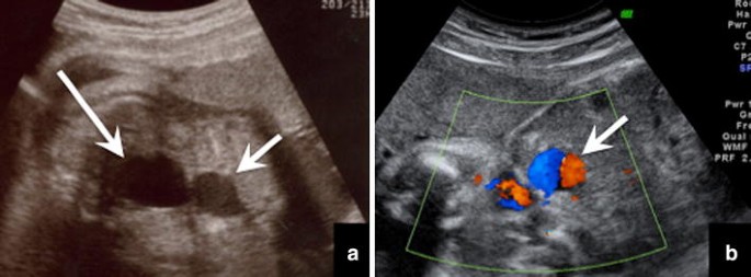 Another Double Bubble Sign Or Double Bladder Sign Fetal Intra Abdominal Umbilical Vein Varix Springerlink Another Double Bubble Sign Or Double Bladder Sign Fetal Intra Abdominal Umbilical Vein Varix Springerlink
