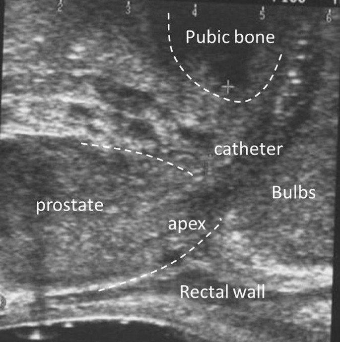 prostate gland anatomy ultrasound