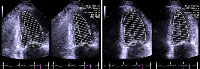 NTNU Open: Global longitudinal strain is a more reproducible measure of  left ventricular function than ejection fraction regardless of  echocardiographic training