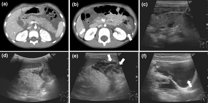 Comparison of the Balthazar score of acute pancreatitis between computed  tomography and ultrasound in children: pitfalls of ultrasound in diagnosing  and evaluating pancreatitis | SpringerLink