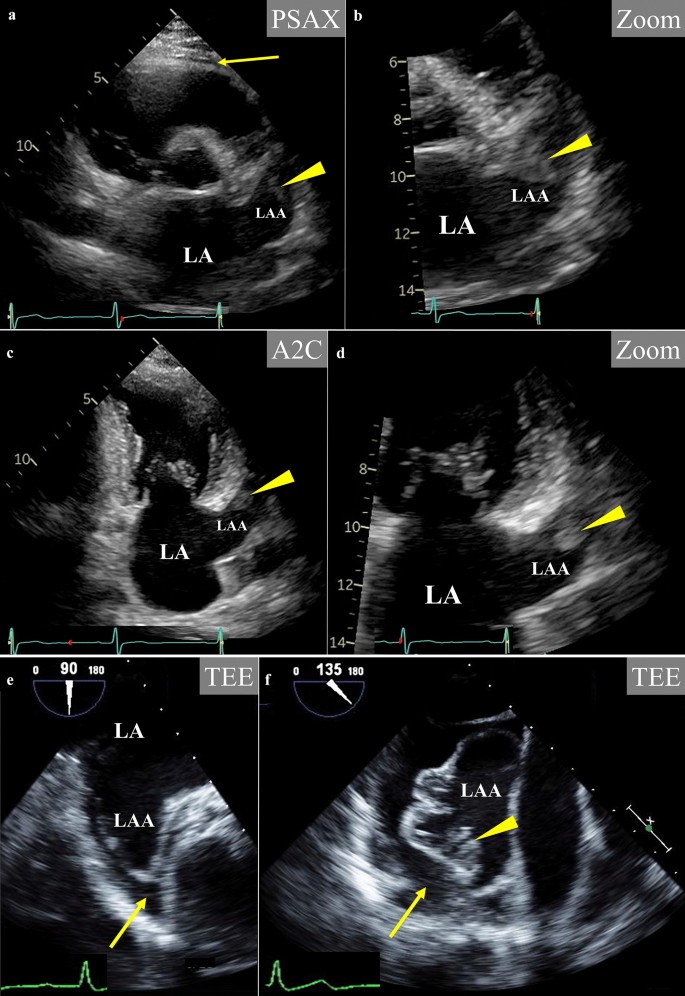 Pseudo-thrombus mechanism in left atrial appendage visualized via  transthoracic echocardiography | SpringerLink