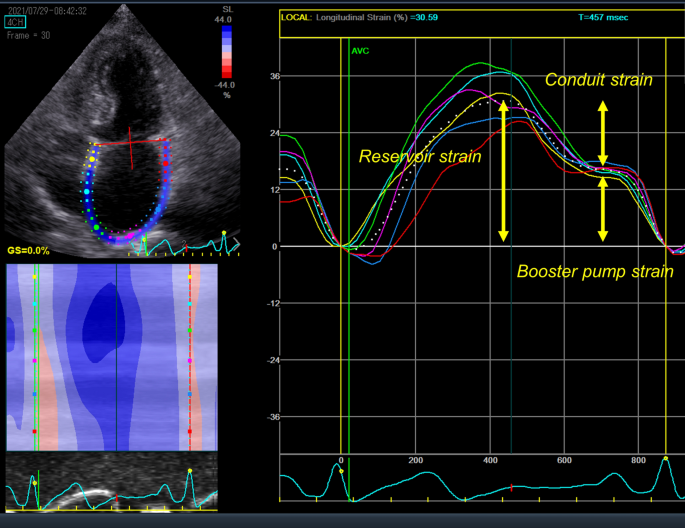 Persistence of abnormal global longitudinal strain in women with peripartum  cardiomyopathy - Bortnick - 2021 - Echocardiography - Wiley Online Library