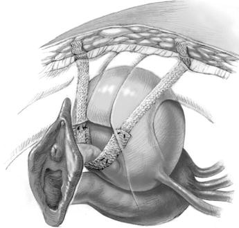 Tension-free vaginal tape (TVT): our modified technique—effective solutions  for postoperative TVT correction | Gynecological Surgery | Full Text