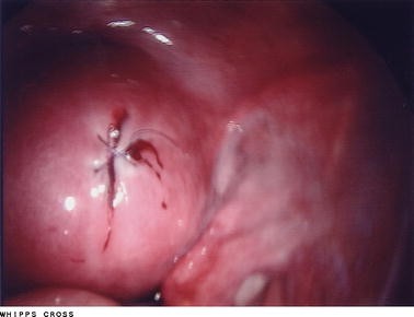 Laparoscopic management of uterine perforation following surgical  termination of pregnancy: a report of three cases and literature review |  Gynecological Surgery | Full Text