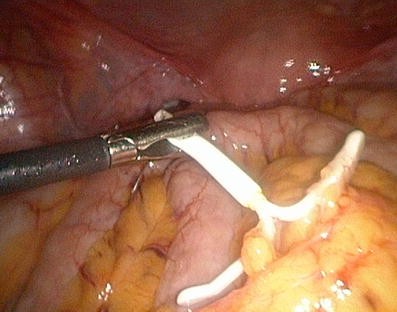 Uterine perforation by the levonorgestrel-releasing intrauterine device:  case report | Gynecological Surgery | Full Text