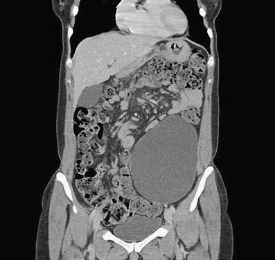 mucinous ovarian cyst