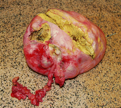 Teratoma tumor