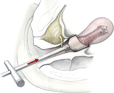 Surgical technique 