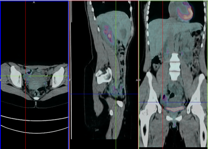 Fdg Pet Value In Deep Endometriosis Gynecological Surgery Full Text