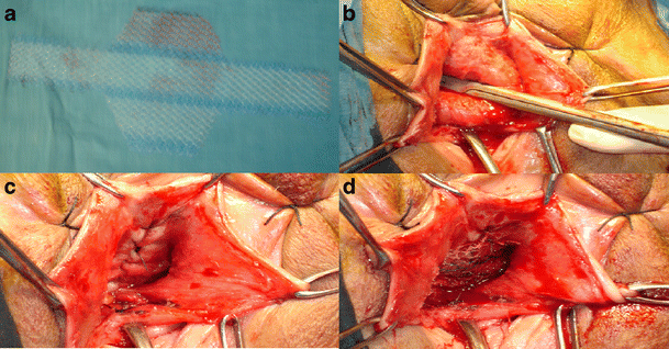 Anterior vaginal prolapse (cystocele) - Diagnosis and treatment